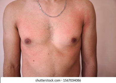 Example Of A Case Of Sun Poisoning, Photosensitivity Or Sun Allergy. The Symptoms Are Skin Rushes, Redness, Itchiness. Swallen Red Eczema. 