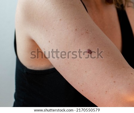 Example of a mole which was diagnosed as carcinogenic cancerous malignant melanoma