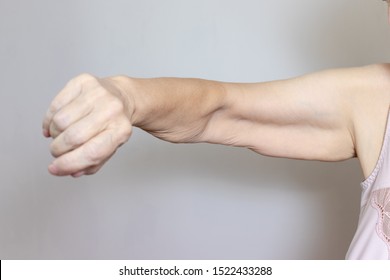 An excess loose skin on an arm of a senior elderly woman after extreme weight loss