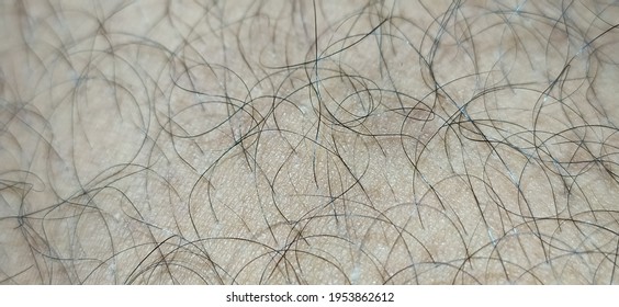 Excessive Curly Black Hairs Growth On Top Layer Of Clean White Human Body Skin Surface. Macro Horizontal Closeup Top View.