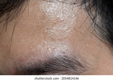 Excessive Sweating Or Hyperhidrosis And Oily Skin At Forehead Of Southeast Asian, Myanmar Or Chinese Adult Young Man. Oily Skin Is The Result Of Overproduction Of Sebum From Sebaceous Glands.