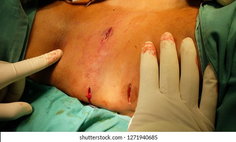 Excision Or Removal Of Subcutaneous Lipoma Undee Aseptic Technique.