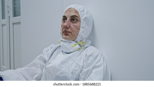 Exhausted Doctor, Nurse Taking Of Coronavirus Protective Gear N95 Mask Uniform. Coronavirus Covid-19 Outbrek.Mental State Of Medical Professional.Face Scars. Mask Shortage. Overworked Health Workers