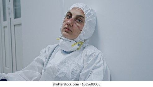 Exhausted Doctor, Nurse Taking Of Coronavirus Protective Gear N95 Mask Uniform. Coronavirus Covid-19 Outbrek.Mental State Of Medical Professional.Face Scars. Mask Shortage. Overworked Health Workers