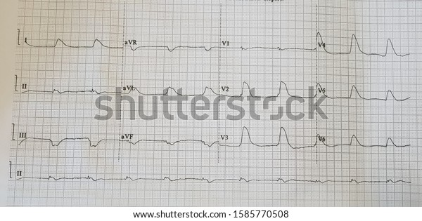 Extensive Anterior Wall St Elevation Myocardial Stock Photo 1585770508 ...