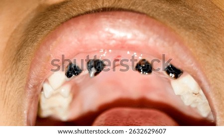 Extensive dental decay affecting the upper teeth. The impact of poor oral hygiene and the need for dental care and preventative measures to maintain healthy teeth and gums.