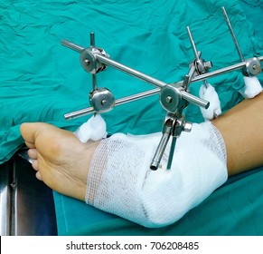 External Fixation Stock Photo 706208485 | Shutterstock