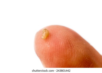 Extracted pimple blackhead on a  finger tip