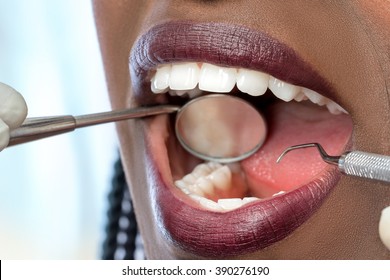 Extreme Close Up Of African Woman Having Dental Check Up.Open Mouth Showing Perfect White Teeth.