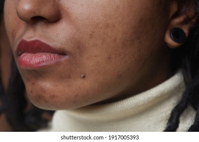 Extreme close up portrait of real African American woman with post acne spots and skin imperfections