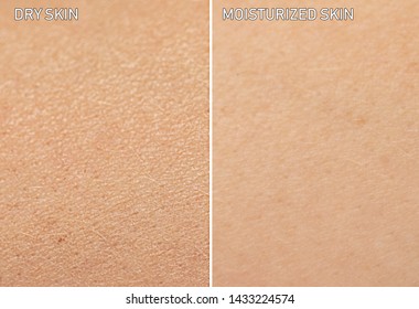 An Extreme Close Up View Of Human Skin, Before And After Moisturizer Is Applied. One Showing Dry Skin, And The Other Showing Healthy Moisturized Skin.