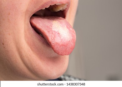 oral candida infection