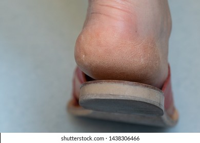 An Extreme Close Up View On The Tough And Cracking Skin Around The Heel And Ankle Of A Middle Aged Woman. Natural Aging Of An Active Woman.