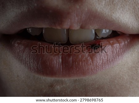 Extreme close-up of damaged lips with bleeding wound, scab, cracked skin and inflammation. Ideal for dermatology, first aid, medical treatment and skincare recovery concepts