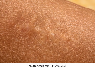 An Extreme Closeup And Detailed View Of Dry Skin Around The Site Of An Old Injury, With Well Healed Scar From Surgical Incision Through Human Body.