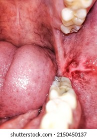 Extreme Closeup Inflamed Ulcerative Growth At Right Upper Gum In Oral Cavity And The Diagnosis Is Oral Cancer - Gum, Oral Care And Dentistry Treatment Concept. Selective Focus