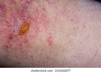 Extreme Close-up Photography Of The Atopic Dermatitis Symptoms On  The Left Elbow Pit Of An Adult Male In A Very Advance Stage.