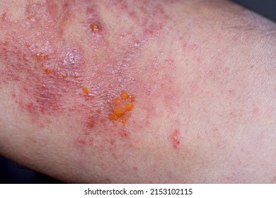 Extreme Close-up Photography Of The Atopic Dermatitis Symptoms On  The Left Elbow Pit Of An Adult Male In A Very Advance Stage.