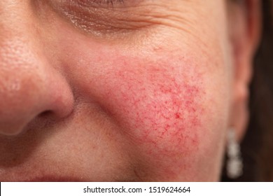 An Extreme Closeup View On The Cheek Of A Woman In Her Forties, A Rosacea Sufferer, With Bright Rosy Red Cheeks And Visible Superficial Dilated Blood Vessels.