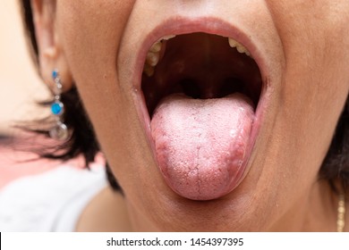 oral thrush tongue