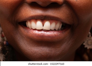 An Extreme Closeup View On The Shiny White Teeth Of A Black Woman, With Toothy Smile And Small Gap In Front Incisors, Real People In Close-up Detail.