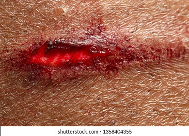 An Extreme Closeup View Of An Open Flesh Wound On Human Skin, Showing The Blood And Scarring. Personal Injury And Pain Concept.