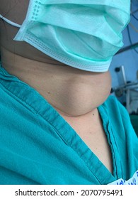 Extremely Large thyroid lump in a young Thai female patient comes with unease to breath