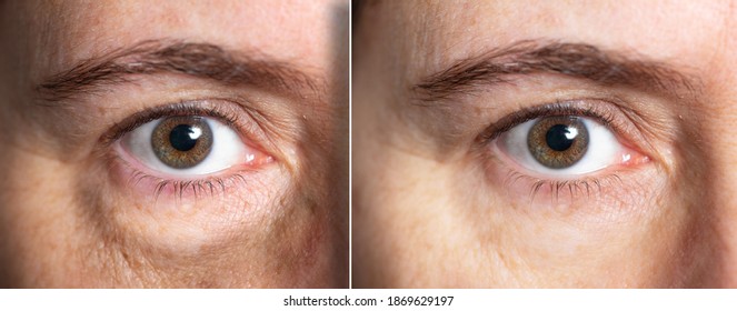 Eye Bags Before And After Cosmetic Treatment. High Quality Photo