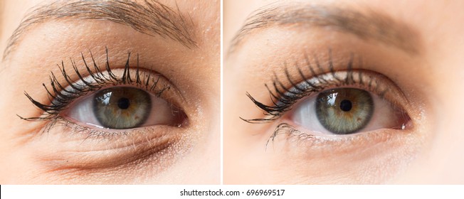 Eye bags before and after cosmetic treatment - Shutterstock ID 696969517