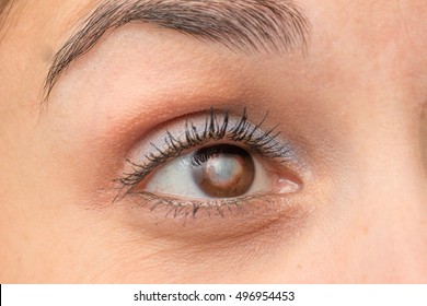 Eye With Cataract