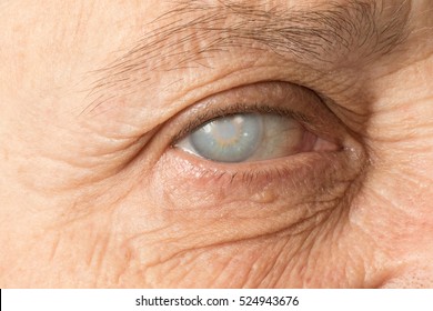 Eye With Cataract