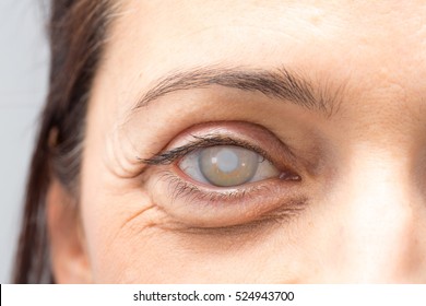 Eye With Cataract