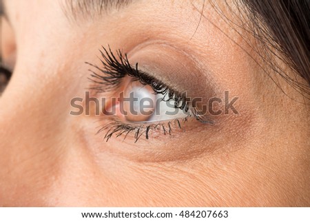 Eye with cataract