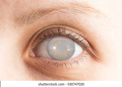 Eye With Cataract And Corneal Opacification