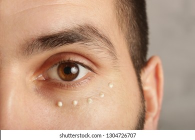 Eye Cream Treatment. Close Up Image Of Man Eye And Cream Dots On The Under Eye Area. Anti Aging Or Dark Circles Prevention.