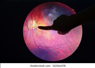 Diabetic Eye Diseases Images, Stock Photos & Vectors | Shutterstock