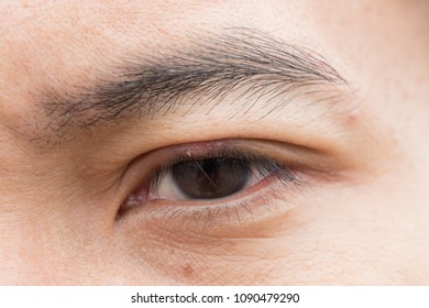 Closeup Vitiligo Spot On Eyebrow Different: foto de stock (editar ahora ...