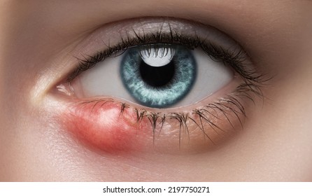 Eye of a girl with stye close-up. Acute purulent inflammation of the hair follicle of the eyelashes of a young woman. Treatment and prevention of eye diseases. - Shutterstock ID 2197750271