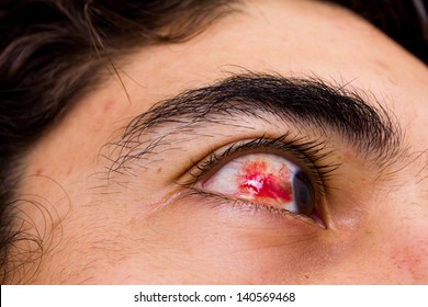 Eye Hemorrhage Showing Blood In The Conjunctiva