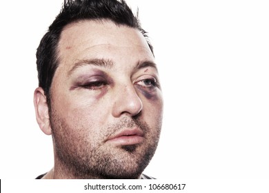 Eye Injury, Male With Black Eye Isolated On White. Man After Accident Or Fight With Bruise