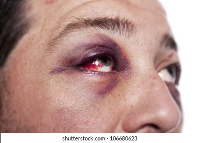 Eye Injury, Male With Black Eye Isolated On White. Man After Accident Or Fight With Bruise