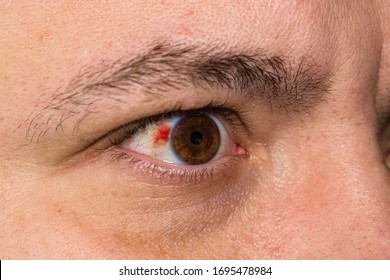 burst blood vessel in eye causes