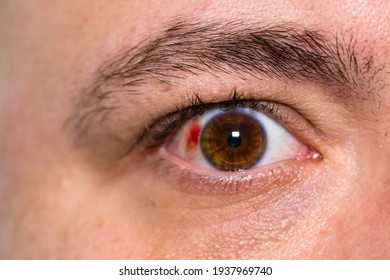 Eye Injury, Young Man With Burst Blood Vessel In Eye, Fatigue, Problems With Blood Vessels