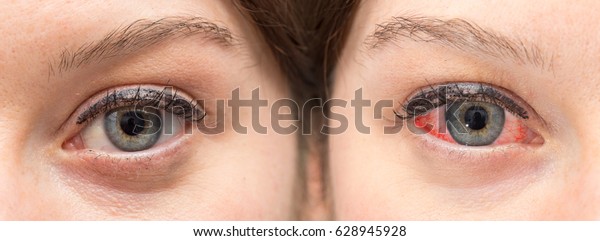 Eye Irritated Before After Use Eye Stock Photo (Edit Now) 628945928