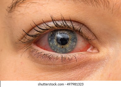 Eye irritation