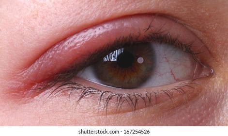 Eye Sty. Closed Woman's Eye With Sty.