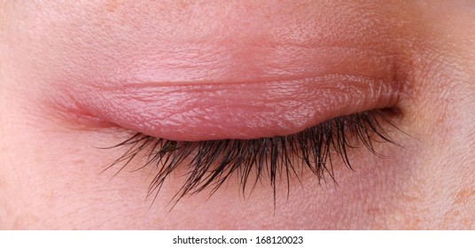 Eye Sty. Closed Woman's Eye With Sty.