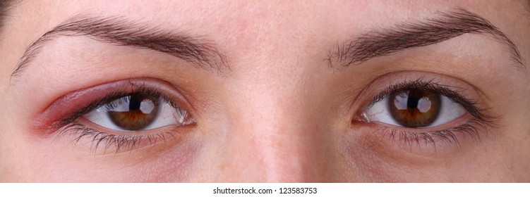 Eye Sty. Opened Woman's Eye With Sty And Health Eye.