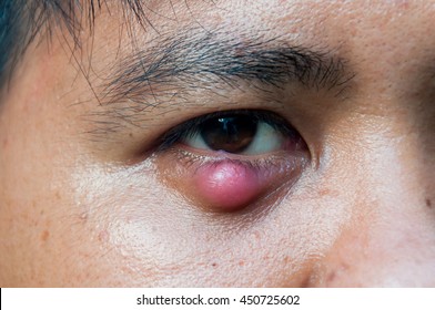 Eye Stye