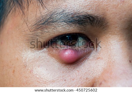 eye stye